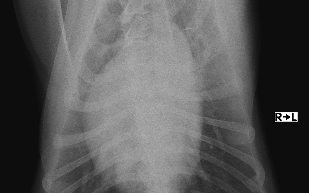Radiographie thoracique de face